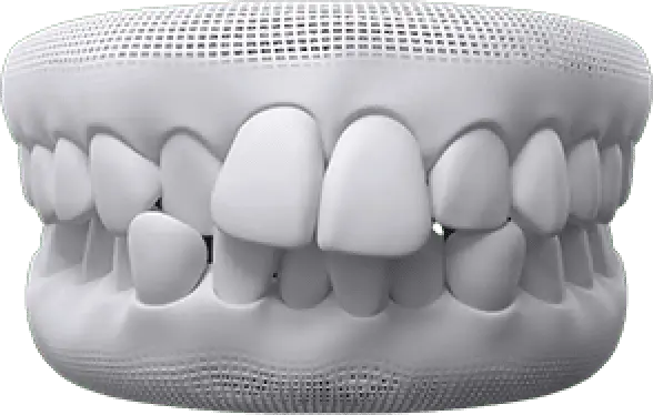 invisalign before after