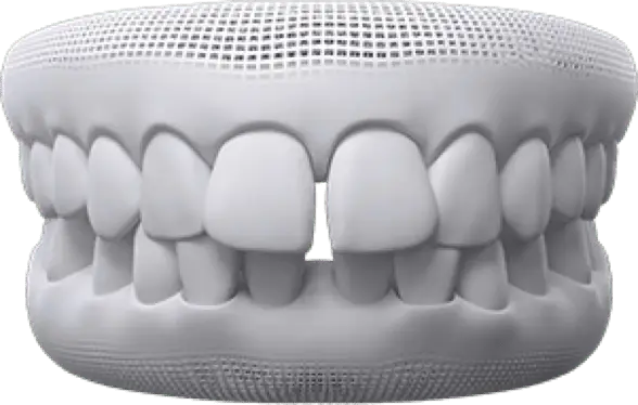 invisalign before after