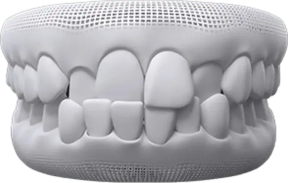 invisalign before after